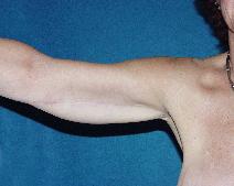 Arm Lift After Photo by John Gross, MD; Orange, CA - Case 7667
