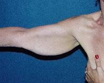 Arm Lift Before Photo by John Gross, MD; Orange, CA - Case 7667
