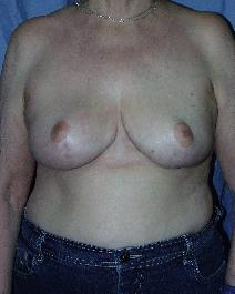 Breast Reduction After Photo by John Gross, MD; Orange, CA - Case 7670