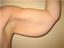 Arm Lift Before Photo by Arnold Breitbart, MD; Manhasset, NY - Case 35425