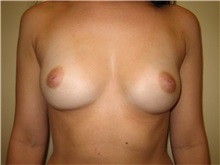 Breast Augmentation Before Photo by Arnold Breitbart, MD; Manhasset, NY - Case 35429