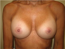 Breast Augmentation After Photo by Arnold Breitbart, MD; Manhasset, NY - Case 35431