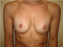 Breast Augmentation Before Photo by Arnold Breitbart, MD; Manhasset, NY - Case 35431