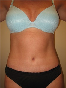 Tummy Tuck After Photo by Arnold Breitbart, MD; Manhasset, NY - Case 35432