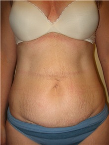 Tummy Tuck Before Photo by Arnold Breitbart, MD; Manhasset, NY - Case 35432