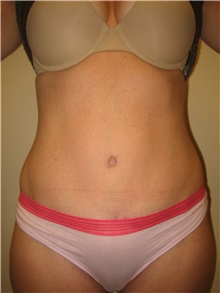 Tummy Tuck After Photo by Arnold Breitbart, MD; Manhasset, NY - Case 35433