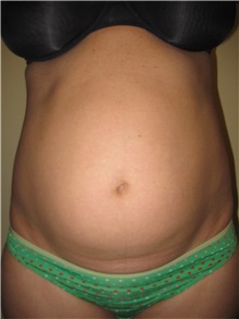 Tummy Tuck Before Photo by Arnold Breitbart, MD; Manhasset, NY - Case 35433