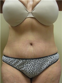 Tummy Tuck After Photo by Arnold Breitbart, MD; Manhasset, NY - Case 35434