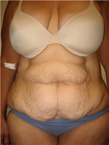 Tummy Tuck Before Photo by Arnold Breitbart, MD; Manhasset, NY - Case 35434