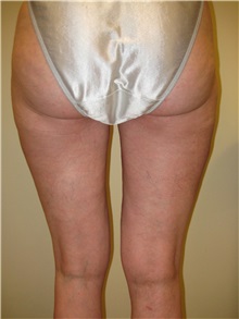 Liposuction After Photo by Arnold Breitbart, MD; Manhasset, NY - Case 35435