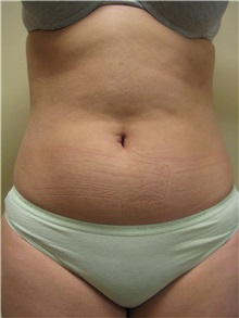 Arm Lift Before Photo by Arnold Breitbart, MD; Manhasset, NY - Case 35436