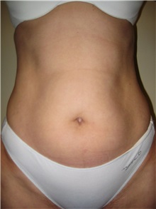 Liposuction Before Photo by Arnold Breitbart, MD; Manhasset, NY - Case 35438