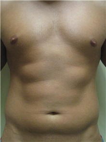 Liposuction Before Photo by Arnold Breitbart, MD; Manhasset, NY - Case 35439