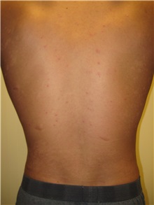 Liposuction After Photo by Arnold Breitbart, MD; Manhasset, NY - Case 35440