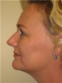 Liposuction After Photo by Arnold Breitbart, MD; Manhasset, NY - Case 35442