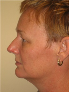 Liposuction Before Photo by Arnold Breitbart, MD; Manhasset, NY - Case 35442