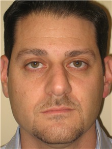 Rhinoplasty Before Photo by Arnold Breitbart, MD; Manhasset, NY - Case 35450