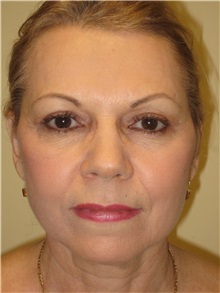 Facelift After Photo by Arnold Breitbart, MD; Manhasset, NY - Case 35451