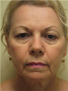 Facelift Before Photo by Arnold Breitbart, MD; Manhasset, NY - Case 35451