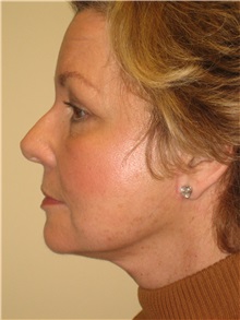 Facelift After Photo by Arnold Breitbart, MD; Manhasset, NY - Case 35453