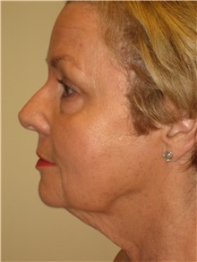 Facelift Before Photo by Arnold Breitbart, MD; Manhasset, NY - Case 35453