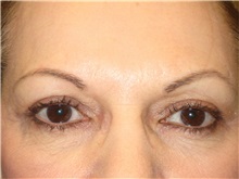 Eyelid Surgery After Photo by Arnold Breitbart, MD; Manhasset, NY - Case 35454