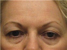 Eyelid Surgery Before Photo by Arnold Breitbart, MD; Manhasset, NY - Case 35454