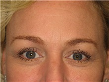 Eyelid Surgery After Photo by Arnold Breitbart, MD; Manhasset, NY - Case 35455