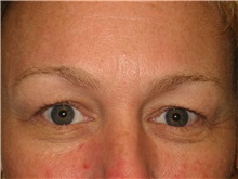 Eyelid Surgery Before Photo by Arnold Breitbart, MD; Manhasset, NY - Case 35455
