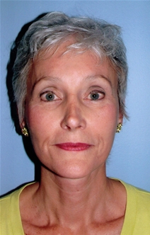 Facelift After Photo by Joseph Woods, MD; Atlanta, GA - Case 22676