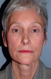 Facelift Before Photo by Joseph Woods, MD; Atlanta, GA - Case 22676