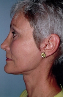 Facelift After Photo by Joseph Woods, MD; Atlanta, GA - Case 22676