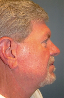 Facelift After Photo by Joseph Woods, MD; Atlanta, GA - Case 22677