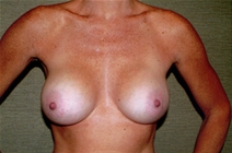 Breast Augmentation After Photo by Joseph Woods, MD; Atlanta, GA - Case 23030