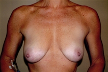 Breast Augmentation Before Photo by Joseph Woods, MD; Atlanta, GA - Case 23030