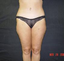 Tummy Tuck After Photo by James Fernau, MD, FACS; Pittsburgh, PA - Case 6790