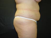 Tummy Tuck Before Photo by James Fernau, MD, FACS; Pittsburgh, PA - Case 6790