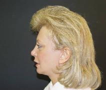 Facelift After Photo by James Fernau, MD, FACS; Pittsburgh, PA - Case 6791