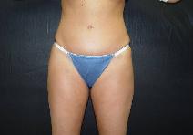 Tummy Tuck After Photo by James Fernau, MD, FACS; Pittsburgh, PA - Case 6792