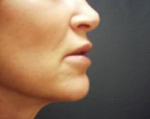 Dermal Fillers After Photo by James Fernau, MD, FACS; Pittsburgh, PA - Case 6795