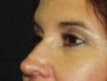 Eyelid Surgery After Photo by James Fernau, MD, FACS; Pittsburgh, PA - Case 6799