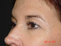 Eyelid Surgery Before Photo by James Fernau, MD, FACS; Pittsburgh, PA - Case 6799
