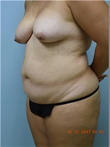 Liposuction Before Photo by Harold Bautista, MD; Fredericksburg, VA - Case 32977