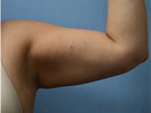 Liposuction After Photo by Harold Bautista, MD; Fredericksburg, VA - Case 32978