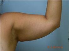 Liposuction Before Photo by Harold Bautista, MD; Fredericksburg, VA - Case 32978