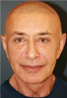 Facelift After Photo by Steve Laverson, MD, FACS; Rancho Santa Fe, CA - Case 34301