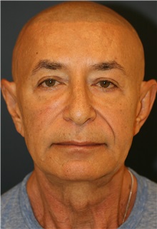 Facelift Before Photo by Steve Laverson, MD, FACS; Rancho Santa Fe, CA - Case 34301