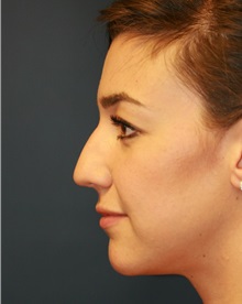 Rhinoplasty Before Photo by Steve Laverson, MD, FACS; San Diego, CA - Case 34302