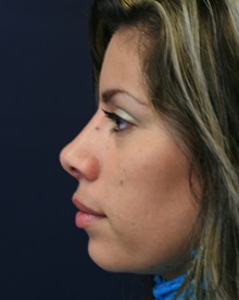 Rhinoplasty After Photo by Steve Laverson, MD, FACS; Rancho Santa Fe, CA - Case 34304