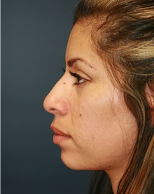 Rhinoplasty Before Photo by Steve Laverson, MD, FACS; Rancho Santa Fe, CA - Case 34304